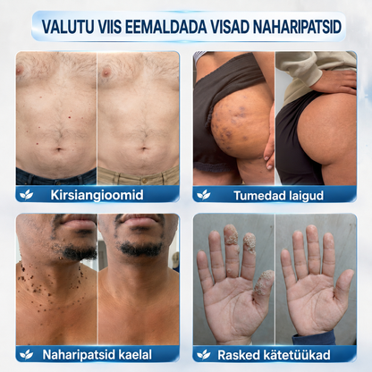 𝐏𝒊𝐜𝐝𝒐® 7-𝒑ä𝒆𝒗 𝑷𝒍𝒆𝒌𝒊𝒆𝒆𝒎𝒂𝒍𝒅𝒖𝒔 𝑨𝒓𝒎𝒊𝒅𝒆 𝒗ä𝒉𝒆𝒏𝒅𝒂𝒎𝒊𝒏𝒆 𝑷𝒍𝒊𝒊𝒂𝒕𝒔💗💗(Zero Pain, Zero Scars rullik)💪